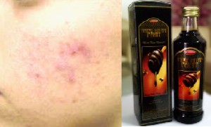 mengatasi jerawat dengan madu pahit