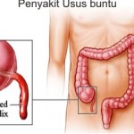 Ciri-ciri Penyakit Usus Buntu