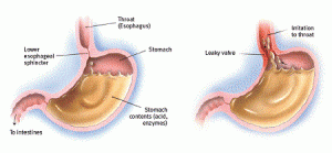 mengatasi dyspepsia
